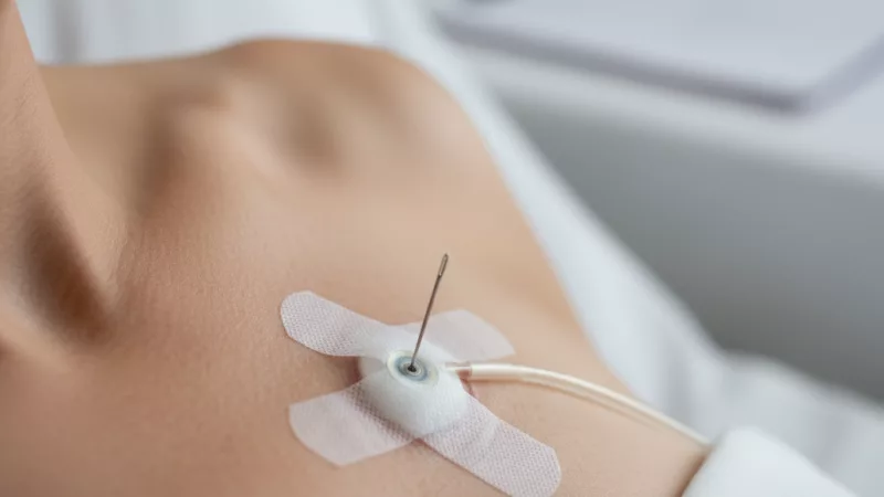 Day 4/100 port-a-cath